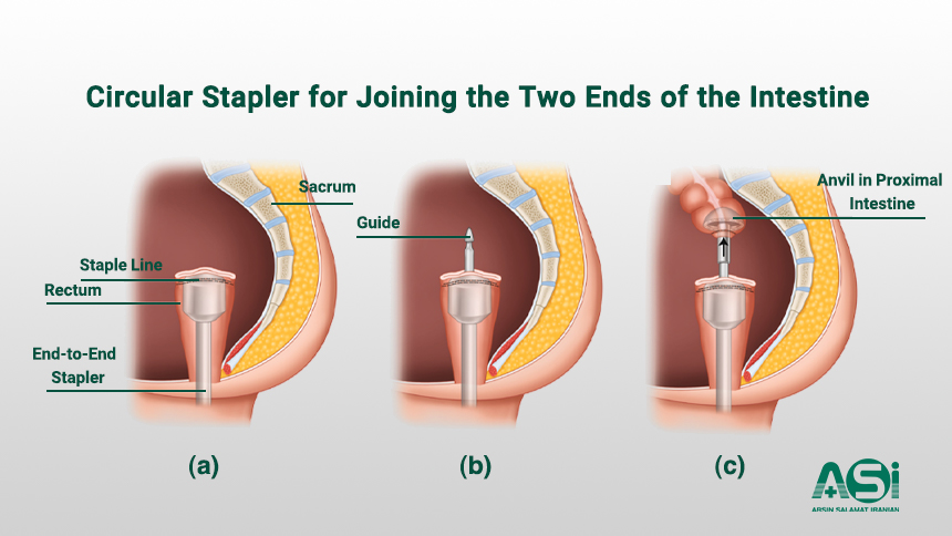 Circular Staplers in Laparoscopic Surgery