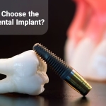 How to Choose the Best Dental Implant?