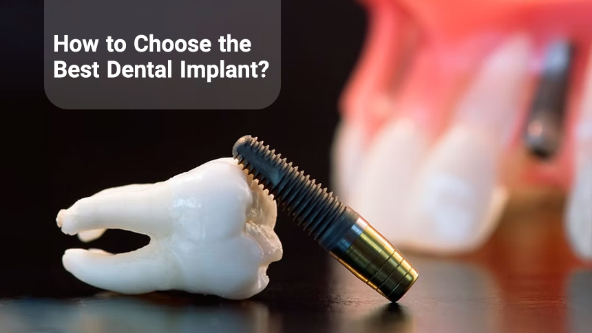 How to Choose the Best Dental Implant?