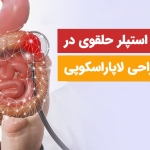 کاربرد استپلر حلقوی در جراحی لاپاراسکوپی