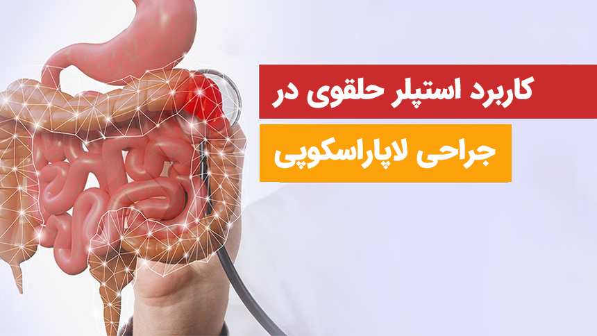 کاربرد استپلر حلقوی در جراحی لاپاراسکوپی