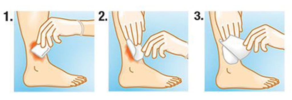 Suprasorb A (سوپرازورب آلژینات کلسیم)