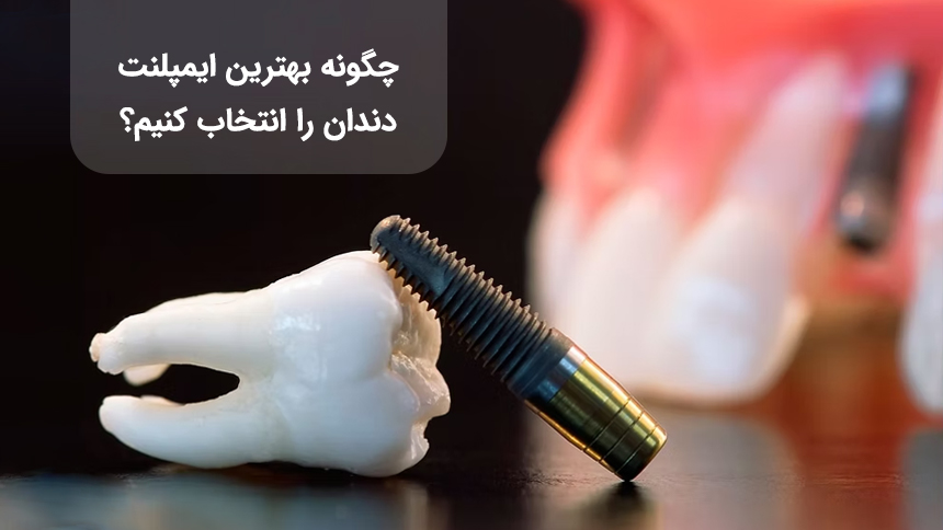 بهترین ایمپلنت دندان